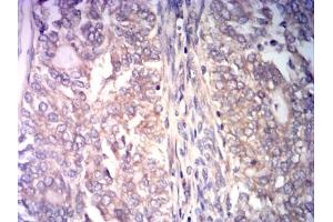 Immunohistochemical analysis of paraffin-embedded cervical cancer tissues using CCNE1 mouse mAb with DAB staining. (Cyclin E1 antibody  (AA 1-100))