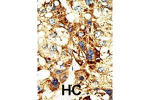 Formalin-fixed and paraffin-embedded human hepatocellular carcinoma tissue reacted with the primary antibody DNMT3A polyclonal antibody  , which was peroxidase-conjugated to the secondary antibody, followed by DAB staining. (DNMT3A antibody  (Internal Region))