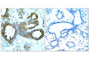Immunohistochemical analysis of paraffin-embedded human breast carcinoma tissue, using PAK1/PAK2/PAK3 (Phospho-Thr423/Thr402/Thr421) antibody (E011165). (PAK1/2/3 antibody  (pThr402, pThr421, pThr423))