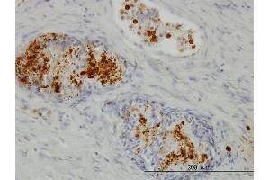 Immunoperoxidase of monoclonal antibody to PIM1 on formalin-fixed paraffin-embedded human prostate. (PIM1 antibody  (AA 1-313))
