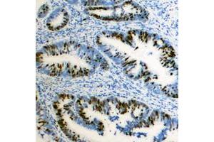 Immunohistochemical analysis of ZEB2 staining in human colon cancer formalin fixed paraffin embedded tissue section. (ZEB2 antibody  (N-Term))
