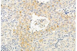 ABIN6265621 and ABIN6272881 at 1/100 staining Human lung cancer by IHC-P. (TMPRSS4 antibody  (Internal Region))