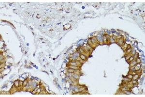 Immunohistochemistry of paraffin-embedded Human mammary cancer using WNT1 Polyclonal Antibody at dilution of 1:100 (40x lens). (WNT1 antibody)