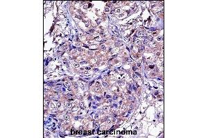 P11 Antibody (C-term) ((ABIN657651 and ABIN2846646))iunohistochemistry analysis in formalin fixed and paraffin embedded human breast carcinoma followed by peroxidase conjugation of the secondary antibody and DAB staining. (MMP11 antibody  (C-Term))