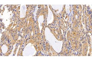 Detection of LAMP2 in Human Thyroid cancer Tissue using Polyclonal Antibody to Lysosomal Associated Membrane Protein 2 (LAMP2) (LAMP2 antibody  (AA 193-375))