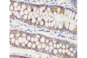 Immunohistochemistry of paraffin-embedded Human colon carcinoma using TOM20 Polyclonal Antibody at dilution of 1:100 (40x lens). (TOMM20 antibody)