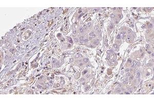 ABIN6273928 at 1/100 staining Human liver cancer tissue by IHC-P.