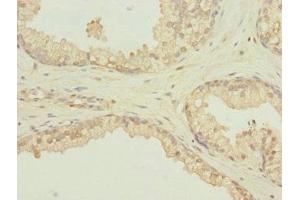 Immunohistochemistry of paraffin-embedded human prostate cancer using ABIN7168604 at dilution of 1:100 (SCAND1 antibody  (AA 1-179))