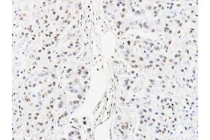 IHC-P Image Immunohistochemical analysis of paraffin-embedded A549 xenograft, using HNRNPAB, antibody at 1:100 dilution. (HNRNPAB antibody)
