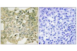 Immunohistochemistry analysis of paraffin-embedded human breast carcinoma tissue using MYT1 (Phospho-Ser83) antibody. (MYT1 antibody  (pSer83))