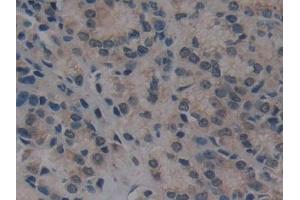 Detection of VIL in Human Prostate cancer Tissue using Polyclonal Antibody to Villin (VIL) (Villin 1 antibody  (AA 1-320))