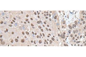 Immunohistochemistry of paraffin-embedded Human esophagus cancer tissue using SMC1A Polyclonal Antibody at dilution of 1:30(x200) (SMC1A antibody)