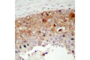 Immunohistochemical analysis of SHCA (pY427) staining in human prostate cancer formalin fixed paraffin embedded tissue section.