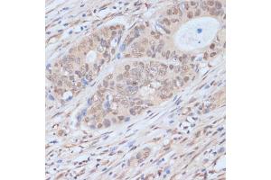 Immunohistochemistry of paraffin-embedded human colon carcinoma using CDK9 antibody (ABIN6129241, ABIN6138331, ABIN6138332 and ABIN6214015) at dilution of 1:100 (40x lens). (CDK9 antibody  (AA 153-372))