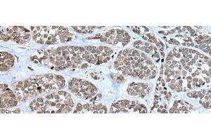 Immunohistochemistry of paraffin-embedded Human esophagus cancer tissue using RPF2 Polyclonal Antibody at dilution of 1:40(x200)