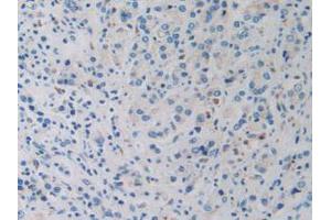 IHC-P analysis of Human Prostate Gland Cancer Tissue, with DAB staining. (DDX58 antibody  (AA 550-776))