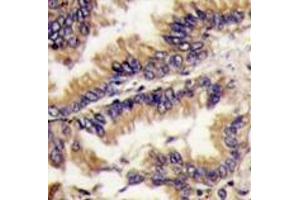 Formalin-fixed and paraffin-embedded human lung carcinoma tissue reacted with MAPK1 Antibody (Center) , which was peroxidase-conjugated to the secondary antibody, followed by DAB staining.