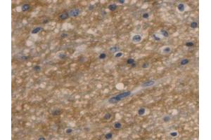 IHC-P analysis of Human Glioma Tissue, with DAB staining. (Aquaporin 4 antibody  (AA 178-317))