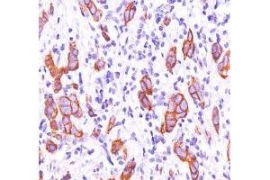 IHC testing of breast invasive carcinoma stained with HER2 antibody (HRB2/451). (ErbB2/Her2 antibody)