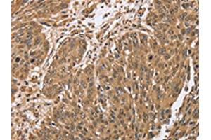 The image on the left is immunohistochemistry of paraffin-embedded Human lung cancer tissue using ABIN7192064(PTPN20A/PTPN20B Antibody) at dilution 1/40, on the right is treated with synthetic peptide. (PTPN2 antibody)