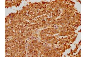IHC image of ABIN7164990 diluted at 1:100 and staining in paraffin-embedded human cervical cancer performed on a Leica BondTM system. (PSMB8 antibody  (AA 176-276))