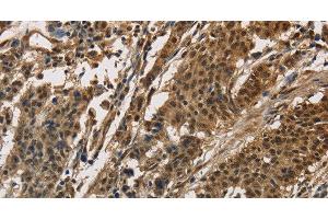 Immunohistochemistry of paraffin-embedded Human gasrtic cancer tissue using CCAR1 Polyclonal Antibody at dilution 1:40 (CCAR1 antibody)