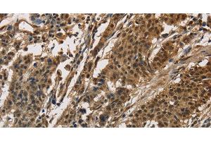 Immunohistochemistry of paraffin-embedded Human gasrtic cancer tissue using CCAR1 Polyclonal Antibody at dilution 1:40