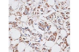 Immunohistochemistry of paraffin-embedded Human breast cancer using KIF14 Polyclonal Antibody at dilution of 1:100 (40x lens). (KIF14 antibody)