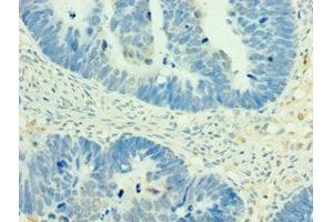 Immunohistochemistry of paraffin-embedded human ovarian cancer using ABIN7160504 at dilution of 1:100