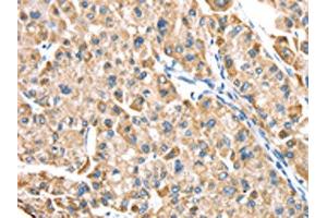 The image on the left is immunohistochemistry of paraffin-embedded Human liver cancer tissue using ABIN7191329(LTB4R2 Antibody) at dilution 1/20, on the right is treated with synthetic peptide. (LTB4R2 antibody)