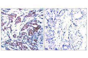 Immunohistochemical analysis of paraffin-embedded human breast carcinoma tissue using c-Jun(Phospho-Ser73) Antibody(left) or the same antibody preincubated with blocking peptide(right). (C-JUN antibody  (pSer73))