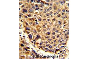 Formalin-fixed and paraffin-embedded human hepatocarcinoma reacted with SPCS3 Antibody , which was peroxidase-conjugated to the secondary antibody, followed by DAB staining. (SPCS3 antibody  (C-Term))