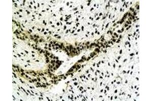 Immunohistochemiacl staining of human gastric carcinoma tissue section with CYC1 polyclonal antibody  at 1:500 dilution.