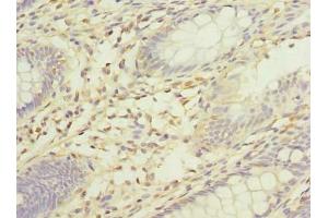 Immunohistochemistry of paraffin-embedded human colon cancer using ABIN7175519 at dilution of 1:100 (Vinexin antibody  (AA 1-329))