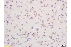 Formalin-fixed and paraffin embedded human glioma tissue labeled with Anti phospho-Dnmt1(Ser154) Polyclonal Antibody, Unconjugated (ABIN757717) at 1:200 followed by conjugation to the secondary antibody and DAB staining (DNMT1 antibody  (pSer154))