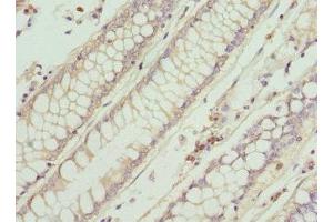 Immunohistochemistry of paraffin-embedded human colon cancer using ABIN7156584 at dilution of 1:100 (IFNB1 antibody  (AA 22-187))