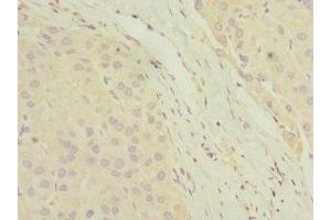 Immunohistochemistry of paraffin-embedded human liver cancer using ABIN7154846 at dilution of 1:100 (HAND2 antibody  (AA 1-217))
