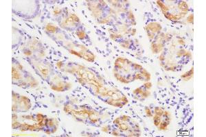 Formalin-fixed and paraffin embedded human gastric carcinoma labeled with Anti-Anei-ATX/Autotaxin Polyclonal Antibody, Unconjugated (ABIN740265) at 1:200 followed by conjugation to the secondary antibody (ENPP2 antibody  (AA 601-700))
