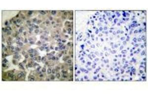 Immunohistochemical analysis of paraffin-embedded human breast carcinoma tissue using PLCG1 (Ab-771) antibody. (Phospholipase C gamma 1 antibody  (Tyr771))