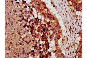 IHC image of ABIN7149298 diluted at 1:300 and staining in paraffin-embedded human lung cancer performed on a Leica BondTM system. (CRLF1 antibody  (AA 318-422))