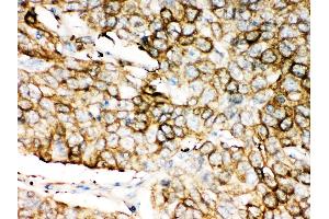 Anti-ALDH1A1 antibody, IHC(P) IHC(P): Human Lung Cancer Tissue (ALDH1A1 antibody  (Middle Region))