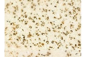 ABIN6261227 and ABIN6268967 at 1/100 staining human melanoma by IHC-P. (DAXX antibody  (C-Term))