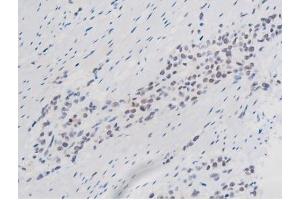 ABIN6267508 at 1/200 staining Human bladder cancer tissue sections by IHC-P. (STAT1 antibody  (pSer727))