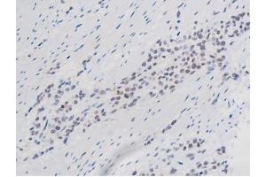 ABIN6267508 at 1/200 staining Human bladder cancer tissue sections by IHC-P.