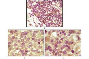 Immunohistochemical analysis of paraffin-embedded human lymphoid (A), ovary tumor (B) and testicle tumor (C) tissues using INHA mouse mAb with DAB staining. (Inhibin alpha antibody)