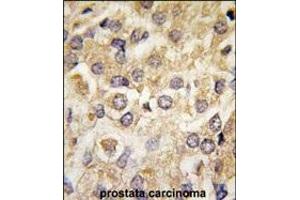 Forlin-fixed and paraffin-embedded hun prostata carcino tissue reacted with P2K2 Antibody  (ABIN6243254 and ABIN6579024) , which was peroxidase-conjugated to the secondary antibody, followed by DAB staining. (MEK2 antibody  (AA 372-400))