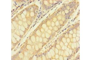 Immunohistochemistry of paraffin-embedded human colon cancer using ABIN7173639 at dilution of 1:100 (TULP3 antibody  (AA 1-260))