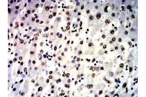 Immunohistochemical analysis of paraffin-embedded liver cancer tissues using IL1B mouse mAb with DAB staining. (IL-1 beta antibody  (AA 117-269))