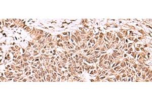 Immunohistochemistry of paraffin-embedded Human ovarian cancer tissue using ACTL6B Polyclonal Antibody at dilution of 1:100(x200) (Actin-Like 6B antibody)