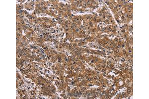 Immunohistochemistry of Human colon cancer using FAAH2 Polyclonal Antibody at dilution of 1:30